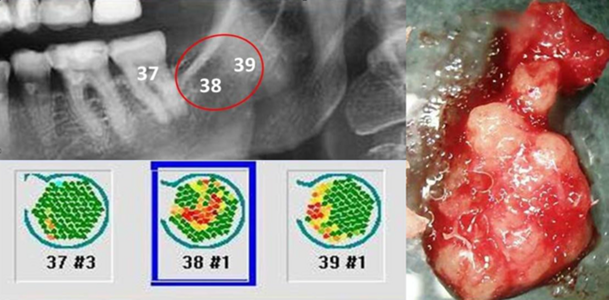 Fig. 4 : Exemple d’exploration ultrasonique avec appareil CaviTAU dans les zones 37-38-39 chez un patient se plaignant de douleurs faciales et fatigue chronique. Le patient rapporte une extraction de la dent de sagesse dans le passé. L’examen révèle une densité diminuée en site 38. Le tissu cureté est montré sur l’image de droite (© Dr Johann Lechner).