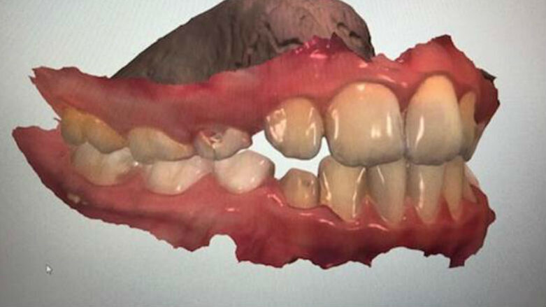 Utilizzo dello scanner intraorale in ortodonzia