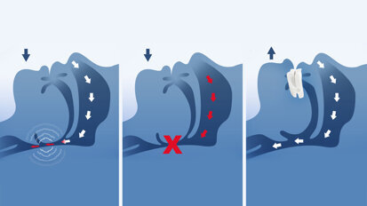 Dentsply Sirona and Panthera Dental announce collaboration for custom-made sleep devices