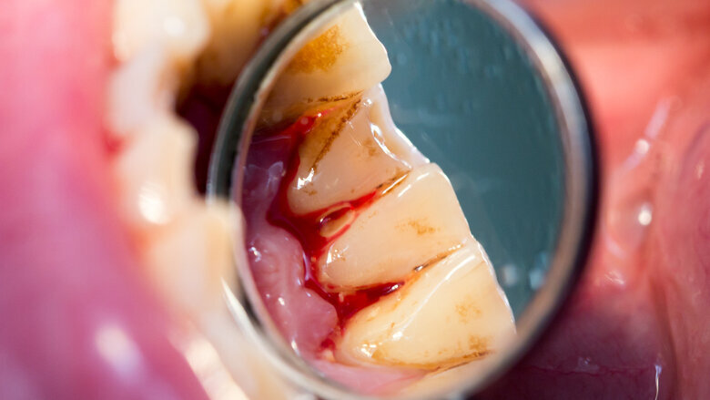 Periodontitis linked to higher mortality rate of cirrhosis patients