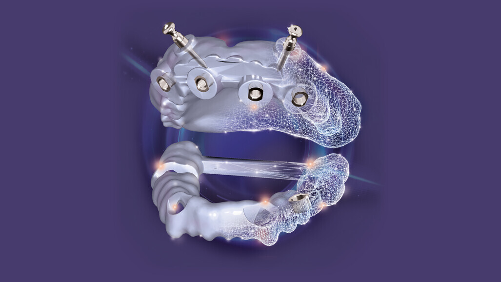 exocad – exoplan