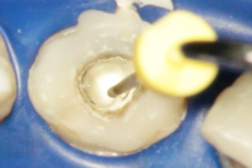 Fig. 2d: (a) Endodontically treated tooth with fistula. (b) After retreatment, the tooth showed an open apex. (c) MTA application with the MAP System and PD MTA White. Condensation of the MTA with pluggers (d) or paper points (e). (f) MTA plug. (g) Post-op radiograph showing the MTA plug and the reconstruction with a fibre post.