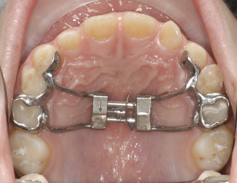 Fig. 24_Leaf expander a 6 mesi.