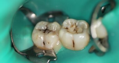 Leczenie próchnicy laserem Er:YAG zgodnie z koncepcją terapii minimalnie inwazyjnej