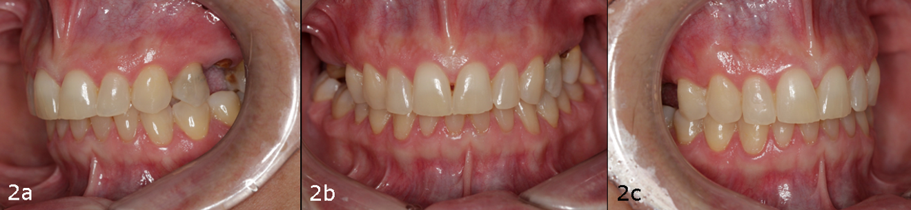 Figs. 2a–c: Intra-oral images of the initial situation.
