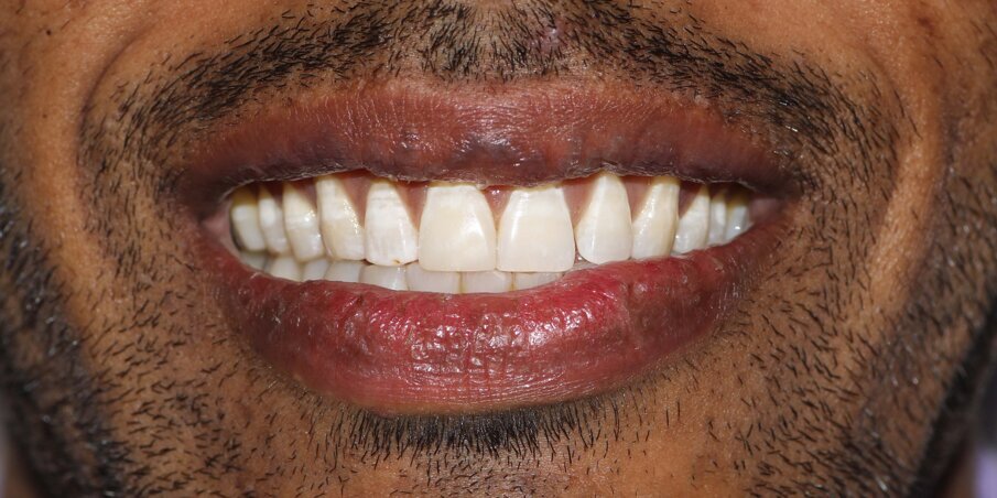 Fig 12: Final Smile