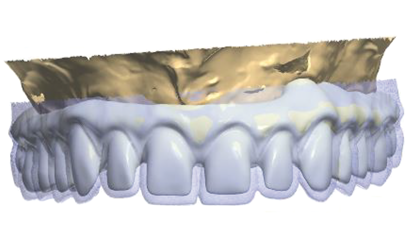 The use of CBCT and CAD/CAM techniques in complex implant-supported rehabilitation of maxilla—Part I