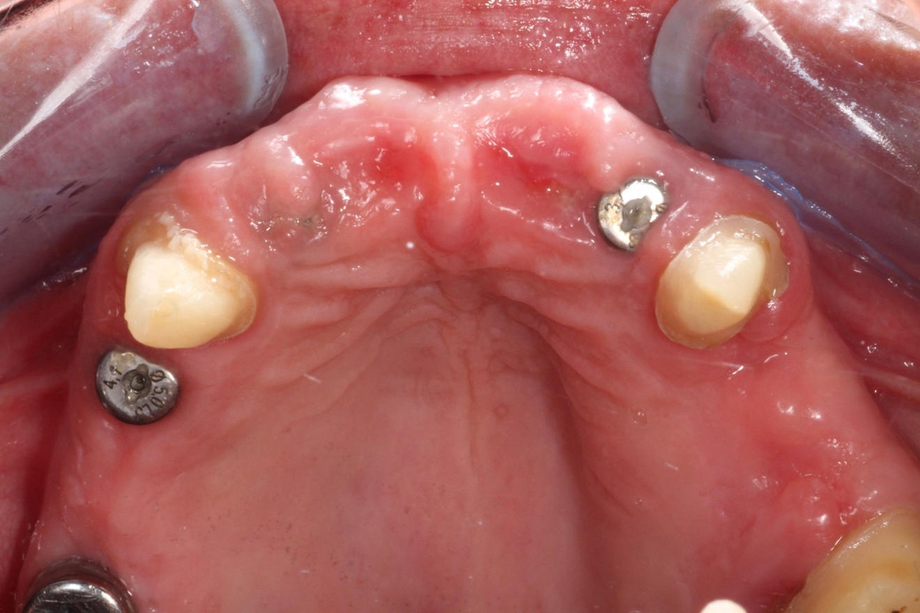 Fig. 11: Clinical situation after a three-month healing period, displaying proper volume of the alveolar ridge in the maxilla.