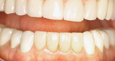 Esthetics, prosthetics, periodontics, implants and bisphosphonates