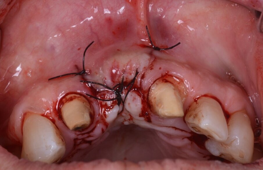 Fig. 20_Suture.
