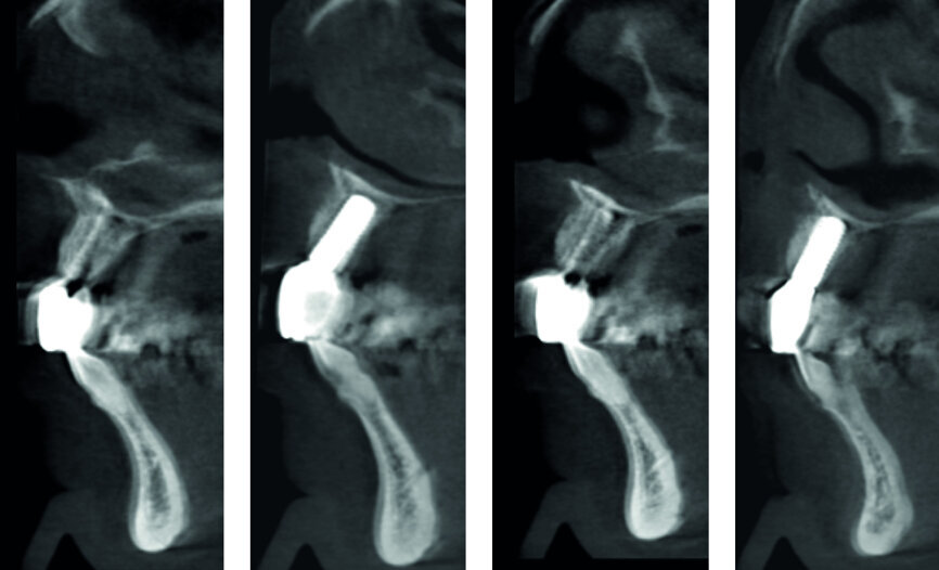 Fig. 50: CT analysis post-op.