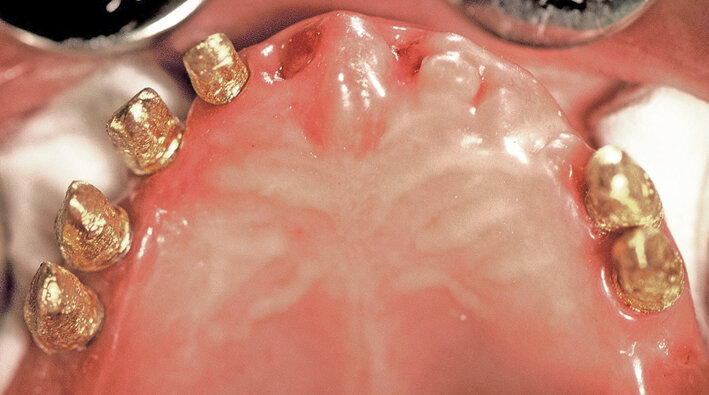 Fig. 10. Fitting of the electroformed copings.