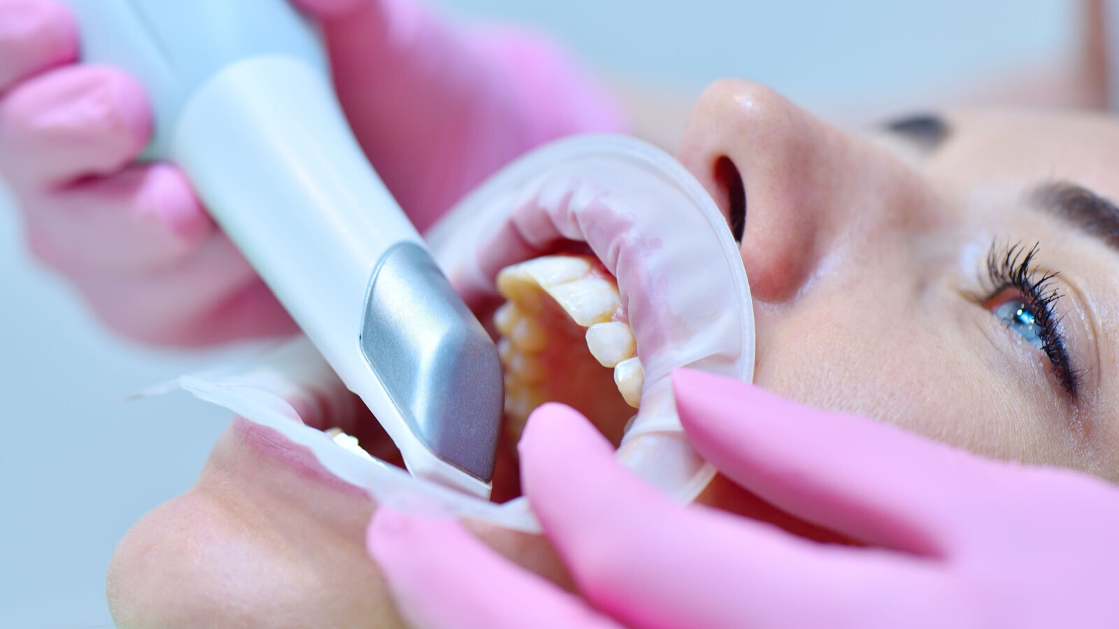 Intraoralni skener održiva alternativa vizuelnoj kliničkoj proceni u otkrivanju karijesa