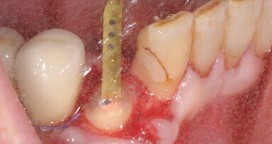 Impianto post-estrattivo e sua protesizzazione immediata. La tecnica di preparazione endo-alveolare del sito implantare con PIEZOSURGERY