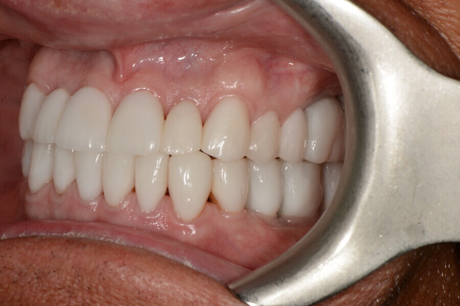 Fig. 32g: Left view of the teeth in intercuspal position.