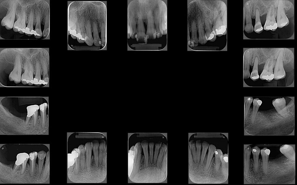 Fig. 7: Periapical radiographs.