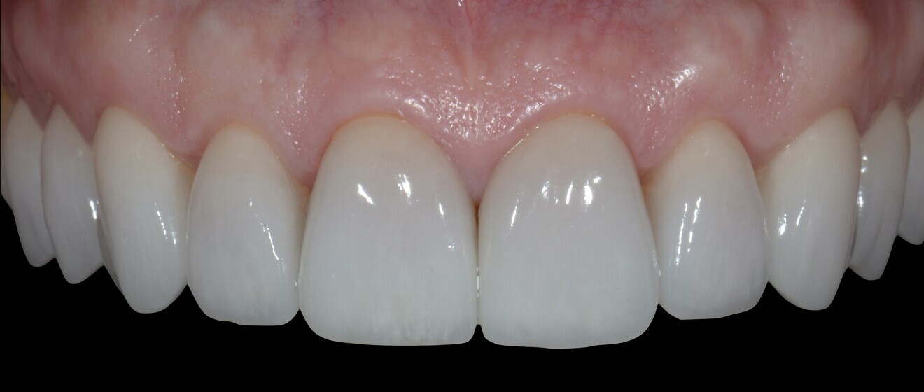 Fig. 16: Restorations at the three-year follow-up.