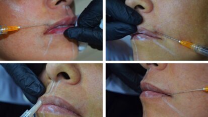 Dentistas y Médicos son los únicos que pueden usar botox y ácido hialurónico