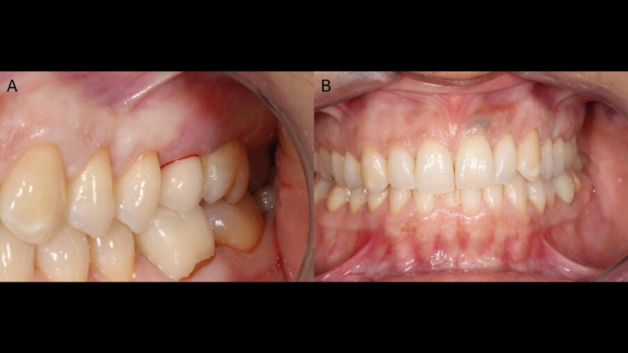 Fig. 1 - Quadro clinico intraorale iniziale. (A) Visione laterale del settore postero-superiore sinistro; (B) visione frontale in occlusione.