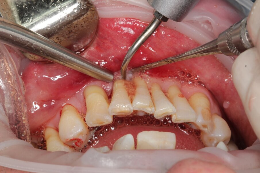 Fig. 9 - Debridement della superfice radicolare durante una procedura di rigenerazione partodontale con tecnica M-MIST. Vengono utilizzati microscollatori parodontali ed inserti parodontali di precisione su manipolo sonico con potenza impostata su livello 1 e 2.