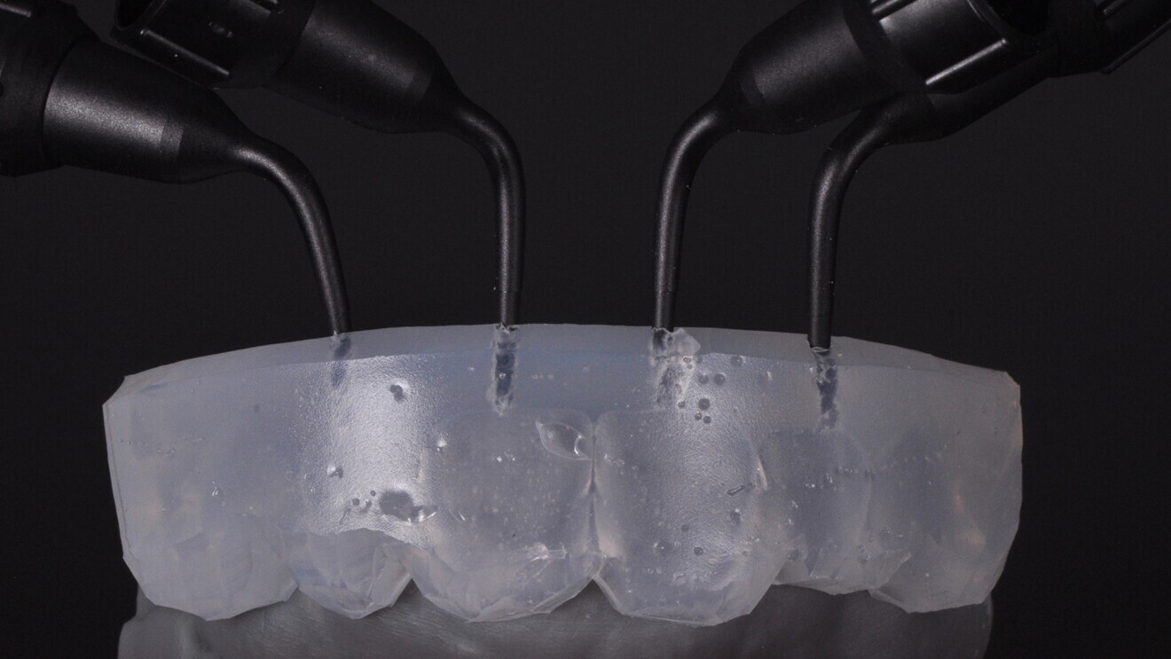Transparent silicone index for the injection step, produced over the wax-up model using an impression tray. The injection holes are ideally integrated with the cannula of the flowable composite syringe, starting inside the index.