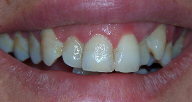 Clinical management del paziente con affollamento dentale
