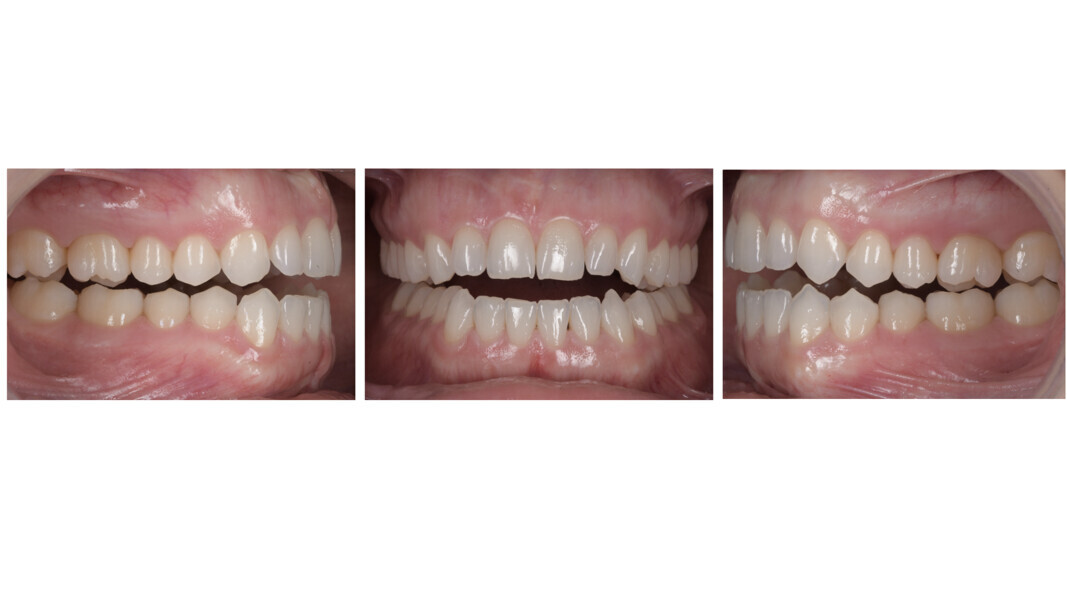 Figs. 42a–c: Occlusal changes after splint therapy.