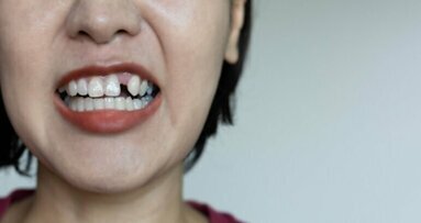 Une étude révèle qu'un mauvais contrôle de la glycémie entraîne la perte de dents à un âge moyen