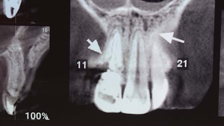 Figuras 2 y 3. Imágenes de tomografía CBCT donde se observa el grado de destrucción de la pared vestibular.