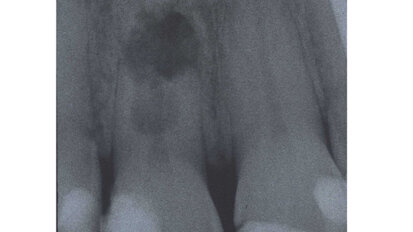 Case report: Internal root resorption rules out restoration
