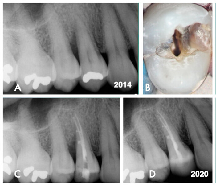 Cas 4 – Fig. A : Un défaut infraosseux de 8 mm était visible le long de la paroi proximale distale de la racine de la dent 15. Fig. B : Les débris présents dans la limite marginale distale de la dent 14 dénotaient une ligne de fracture ; toutefois, rien n’indiquait une séparation cuspidienne. Le retrait de l’amalgame a révélé une extension de la fracture sur le pan cuspidien de la ligne de transition vestibulaire et axiale sous l’effet des contraintes. Fig. C : L’espace canalaire a été obturé par une technique de condensation verticale à chaud. La présence de canaux latéraux a été notée. Fig. D : Une radiographie périapicale postopératoire prise en 2020 a montré une régénération osseuse et une reformation du desmodonte dans le défaut infraosseux qui était présent le long de la paroi distale de la racine