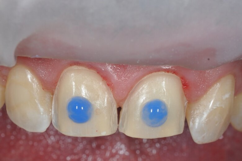 Fig. 7 Spot etching before bonding the temporary veneers in place.