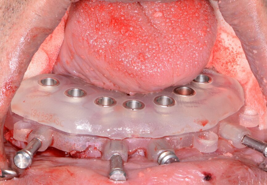 Fig. 17: Mandibular implant surgical
guide.