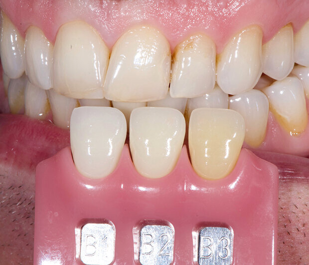 Fig. 2: Determining the basic tooth shade