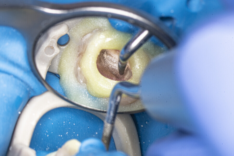 Fig. 51: Removal of the calcification with a diamond-coated ultrasonic tip.