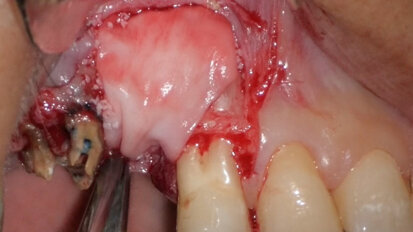 Use of 3D technology in the diagnosis and treatment of endodontic disease