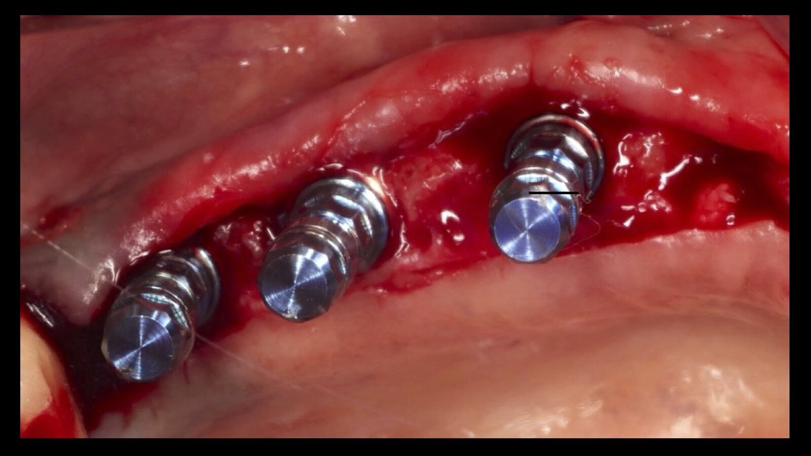 Efecto de la vitamina D en la osteointegración de los implantes dentales