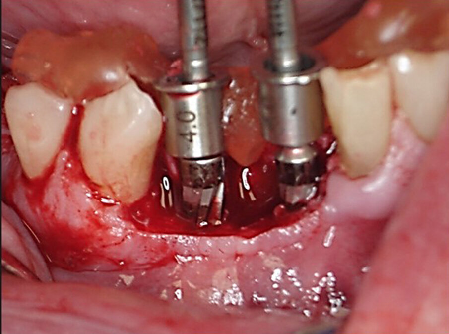 Fig. 13: Densah osseodensication drills used through the Guide Right surgical guide to create the osteotomies for the implants to be placed.