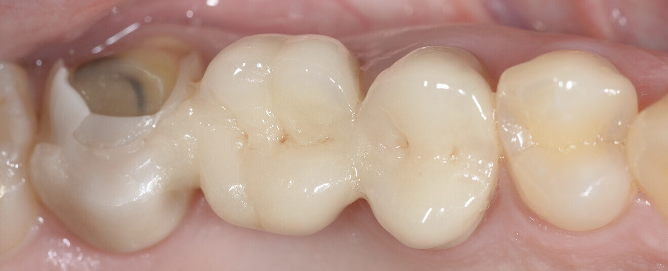 Fig. 1: Pre-op view of the fractured ceramic crown.