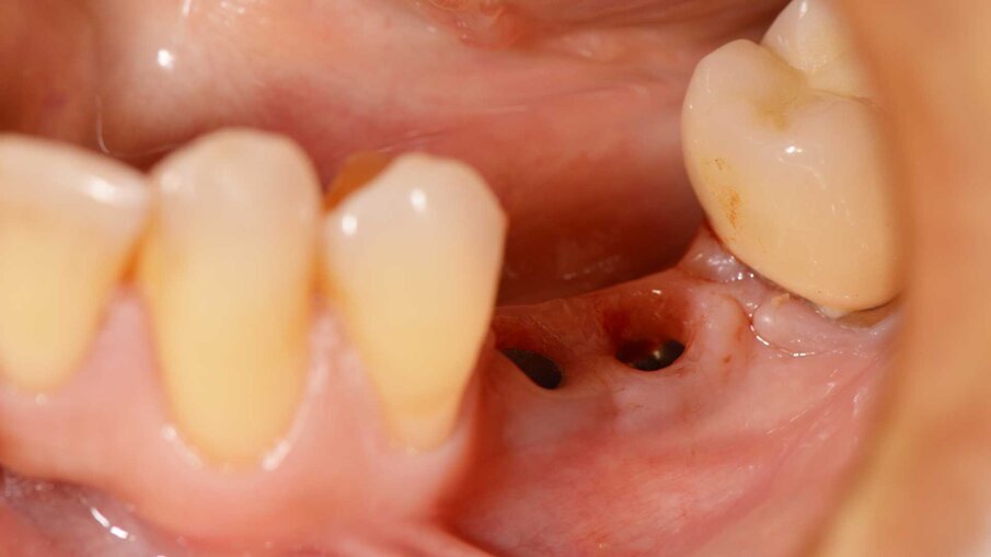 Fig. 8 - Aspetto clinico del tragitto transmucoso a 3 mesi dal trattamento.