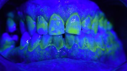 Il Tailored Brushing Method (T.B.M.): un approccio efficace per il controllo del biofilm batterico