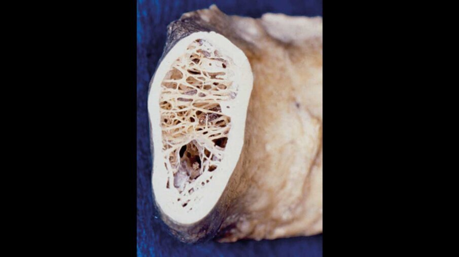 Fig. 3_Struttura interna dell’osso alveolare.