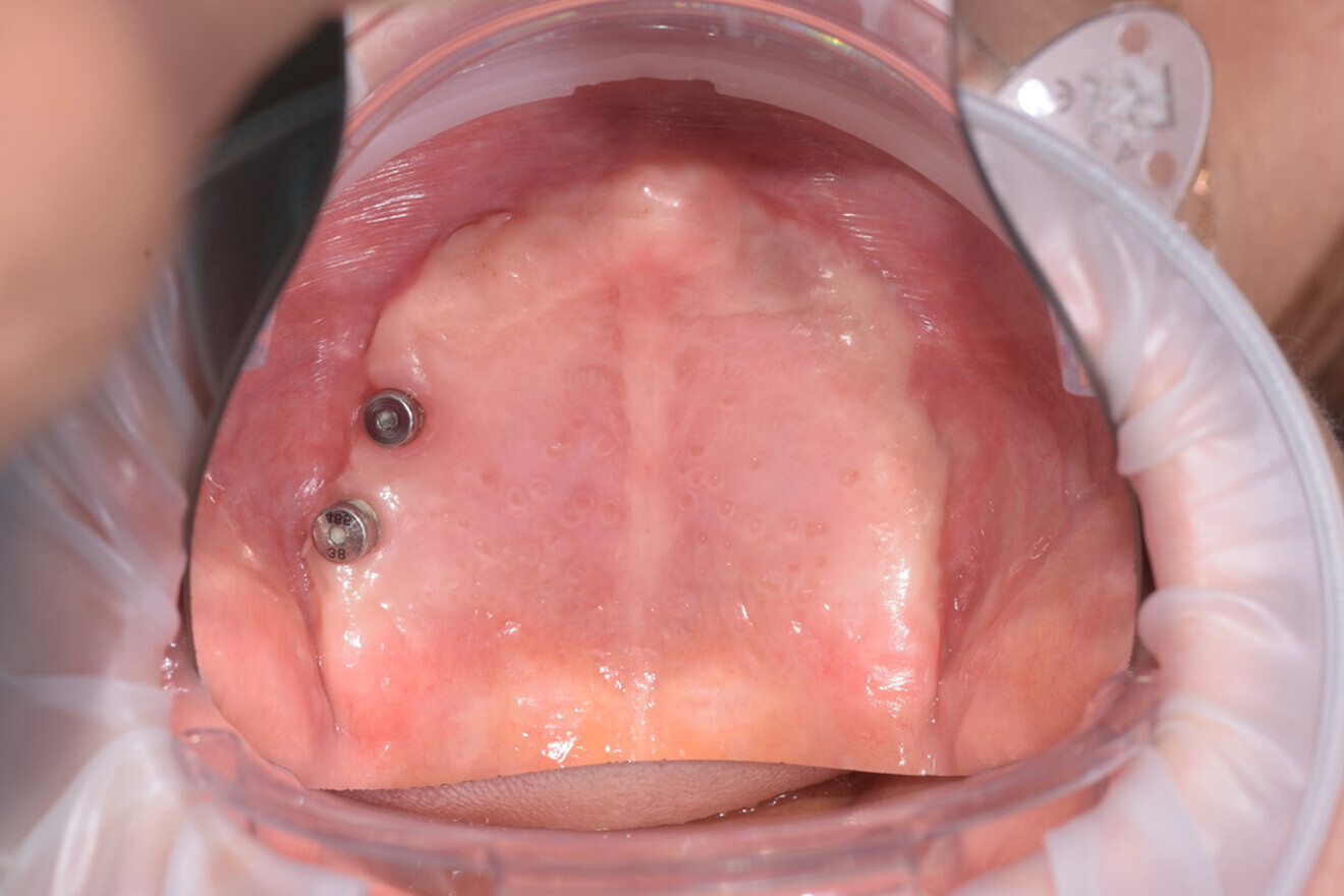 Fig. 2: Situation in the maxilla before treatment.
