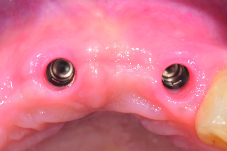 Fig. 11: The emergence profile three months post-op.