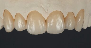Cementation of zirconia