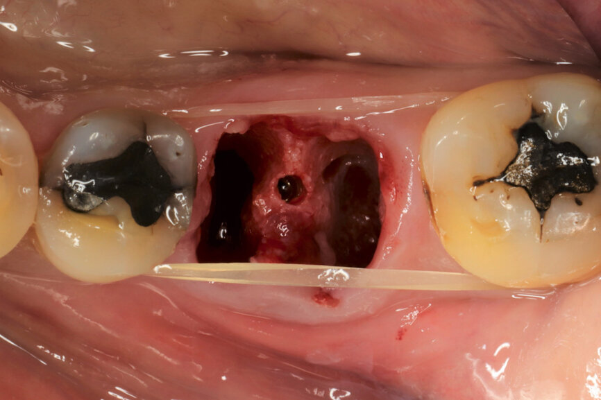 Fig. 7: Centrally oriented osteotomy.