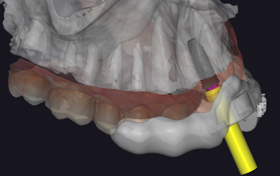 Fig. 9c: Virtual surgical guide design in exoplan with a sleeve for implant placement, lateral view.