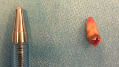 Case report presents rare incidence of retained tooth in nasal cavity