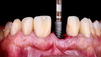 A fully digital approach to soft-tissue and aesthetic excellence