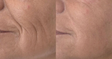 Ringiovanimento del viso con tecnica intraorale grazie al laser Fotona Er:YAG 2940 nm SMOOTH Mode